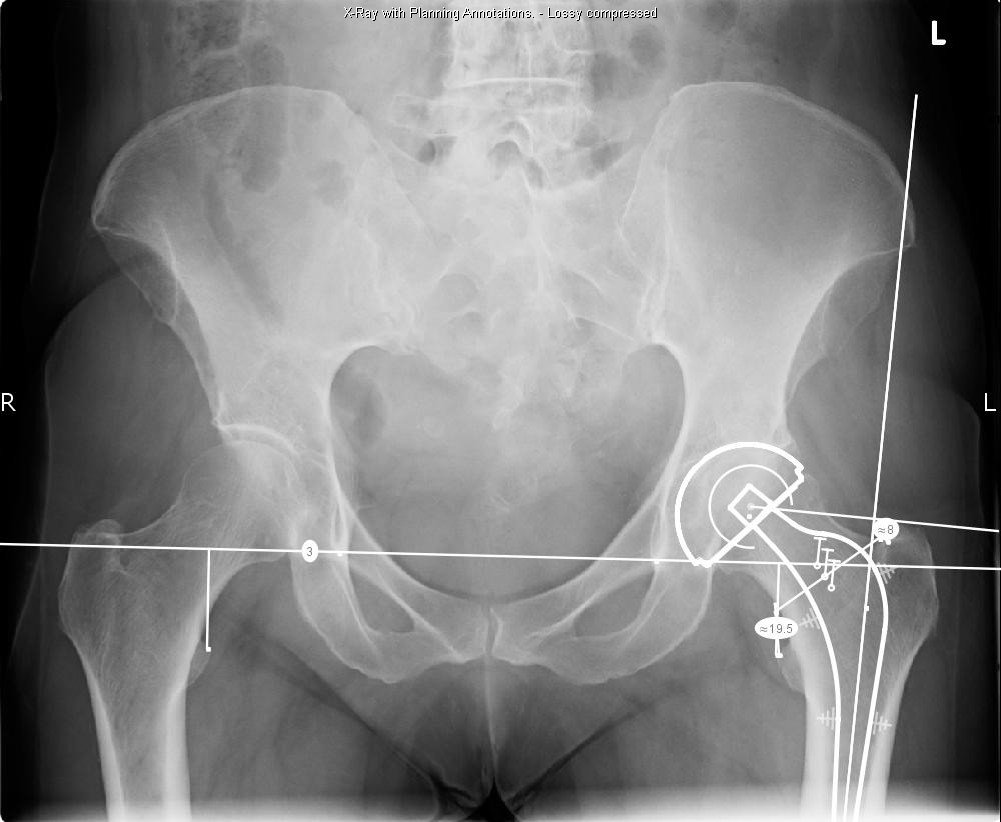 Hip Replacement Planning